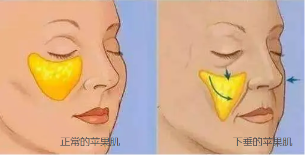 苹果肌下垂