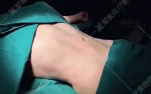 腰腹吸脂效果
