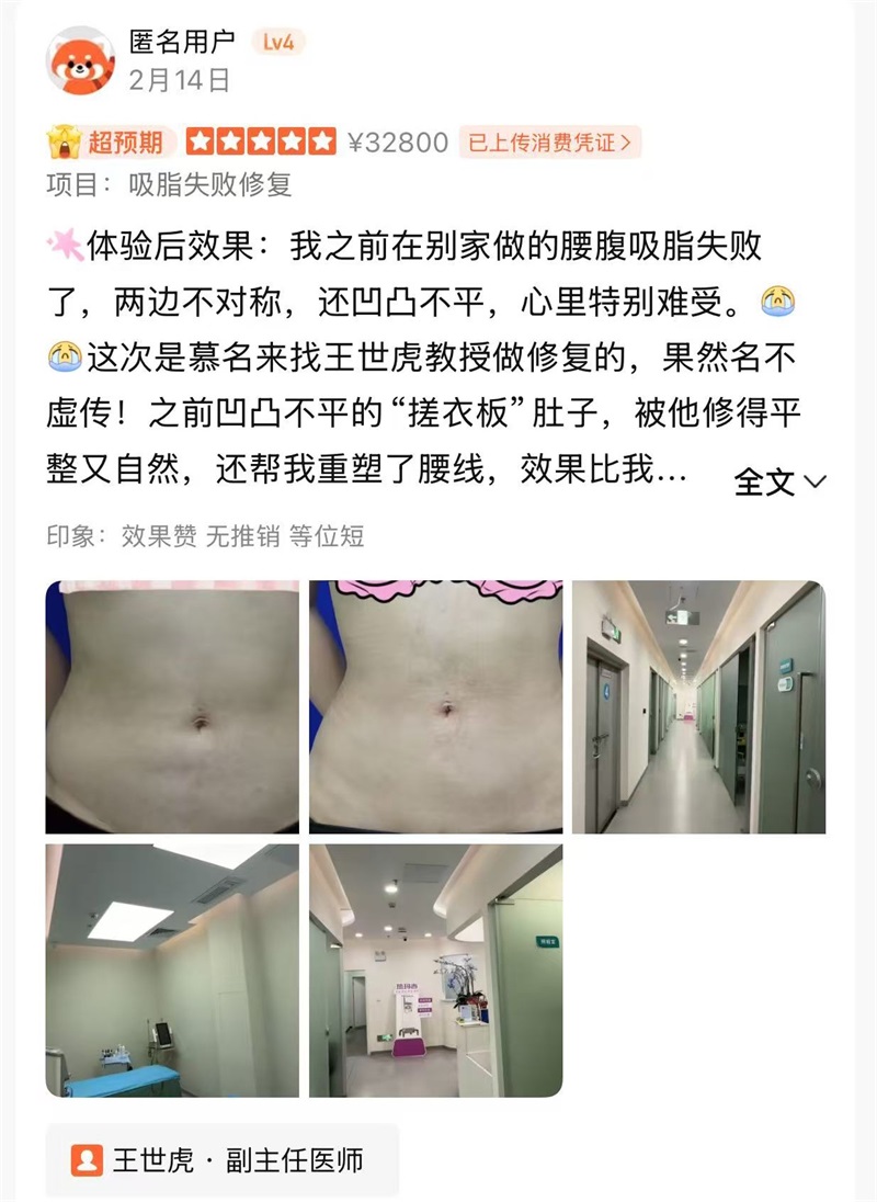 王世虎腰腹吸脂失败修复口碑好评