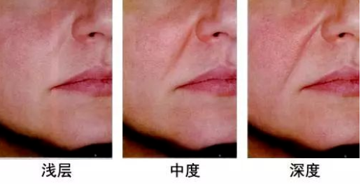 鼻基底凹陷是什么原因造成的
