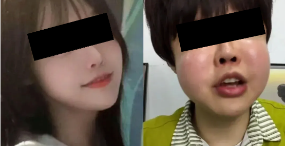 自体脂肪填充存活率多高