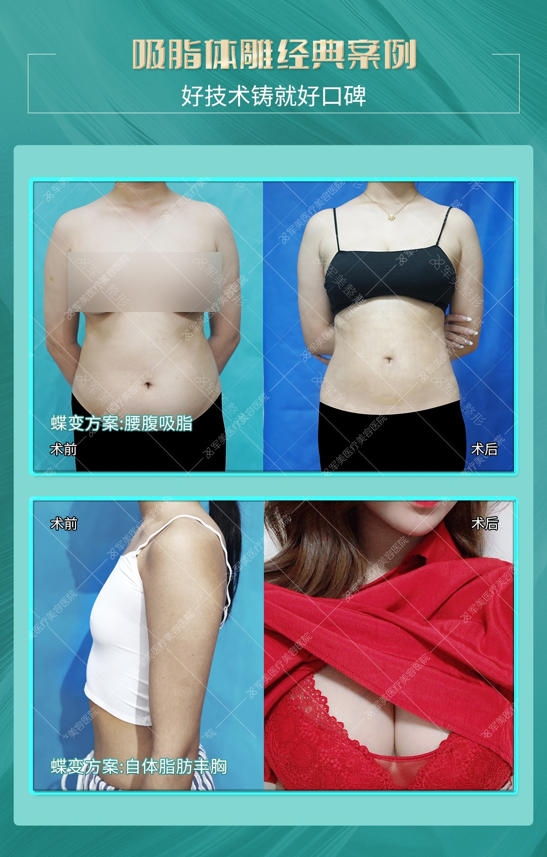 广州军美王娜抽脂案例