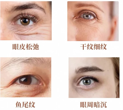 黑眼圈怎么改善
