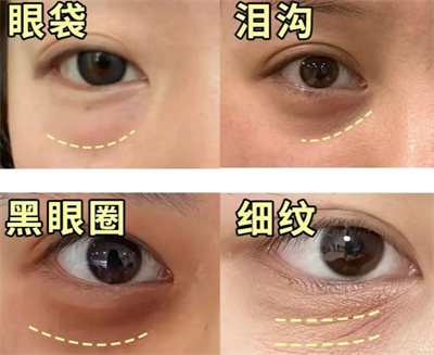 眼周年轻化的科学改善方法