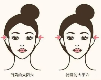 面部脂肪填充