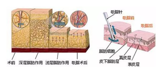 吸脂原理图
