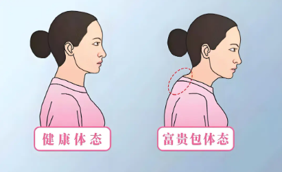 富贵包吸脂