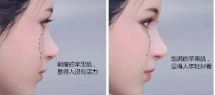 脸垮下垂怎么改善