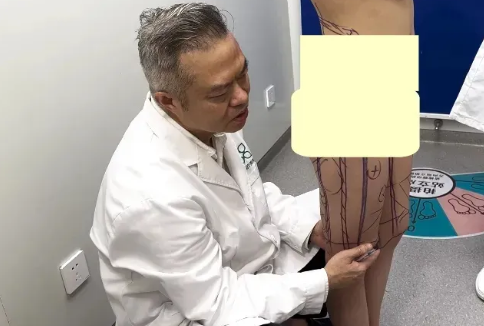 王世虎吸脂