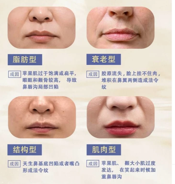 法令纹怎么消除