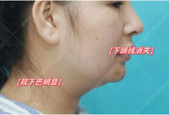 双下巴吸脂案例
