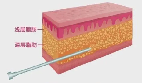 腰腹环吸