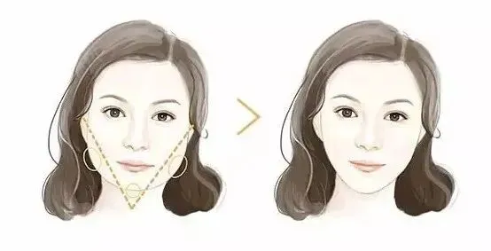 自体脂肪填充面部