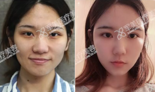 自体脂肪填充面部案例