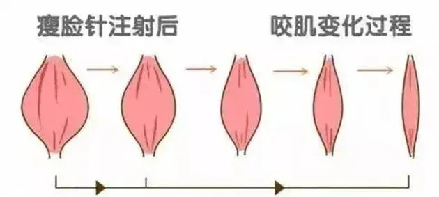 面部凹陷怎么恢复饱满