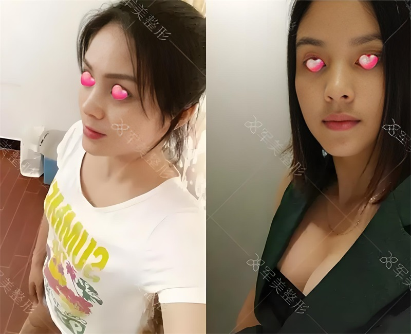 复合隆胸_看图王.png