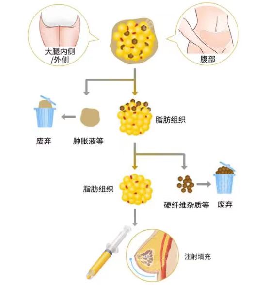 自体脂肪填充原理