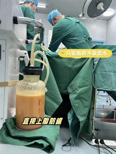 面部脂肪填充过程