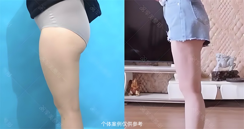 王世虎大腿吸脂案例