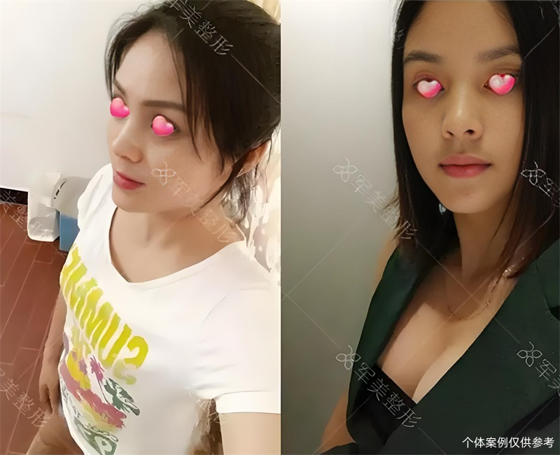 王世虎复合隆胸案例