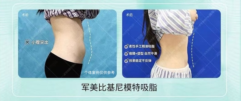 王世虎腰腹吸脂案例