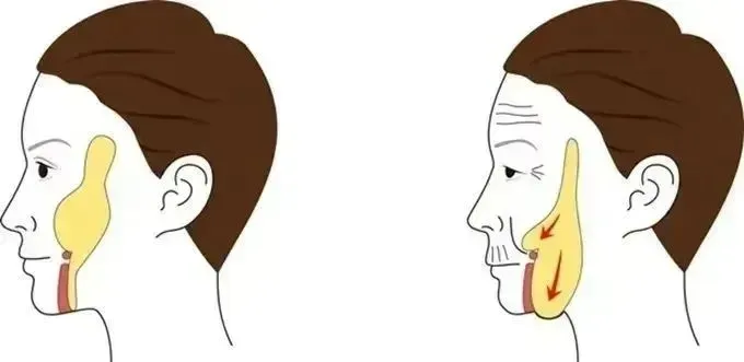 下颌线模糊原因