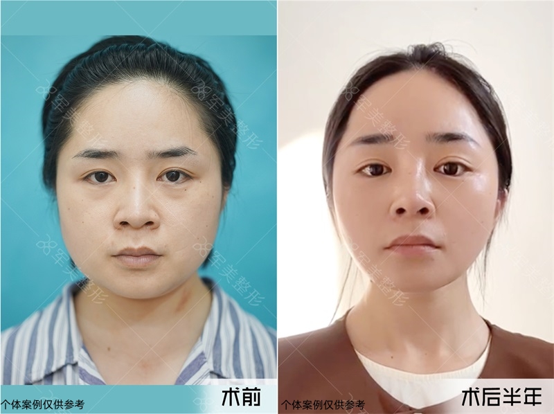 小V脸案例