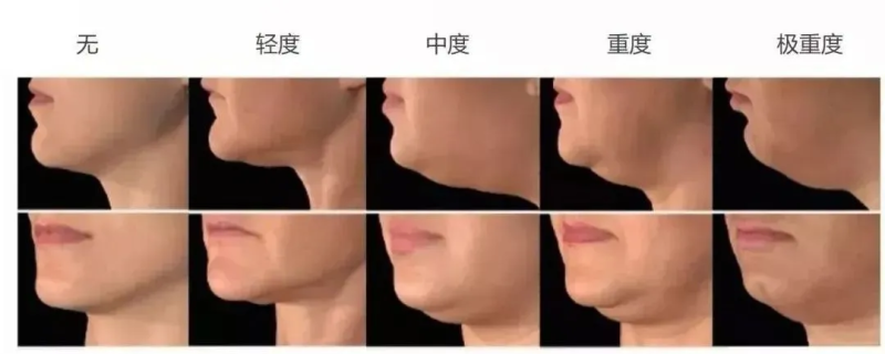 面部提升