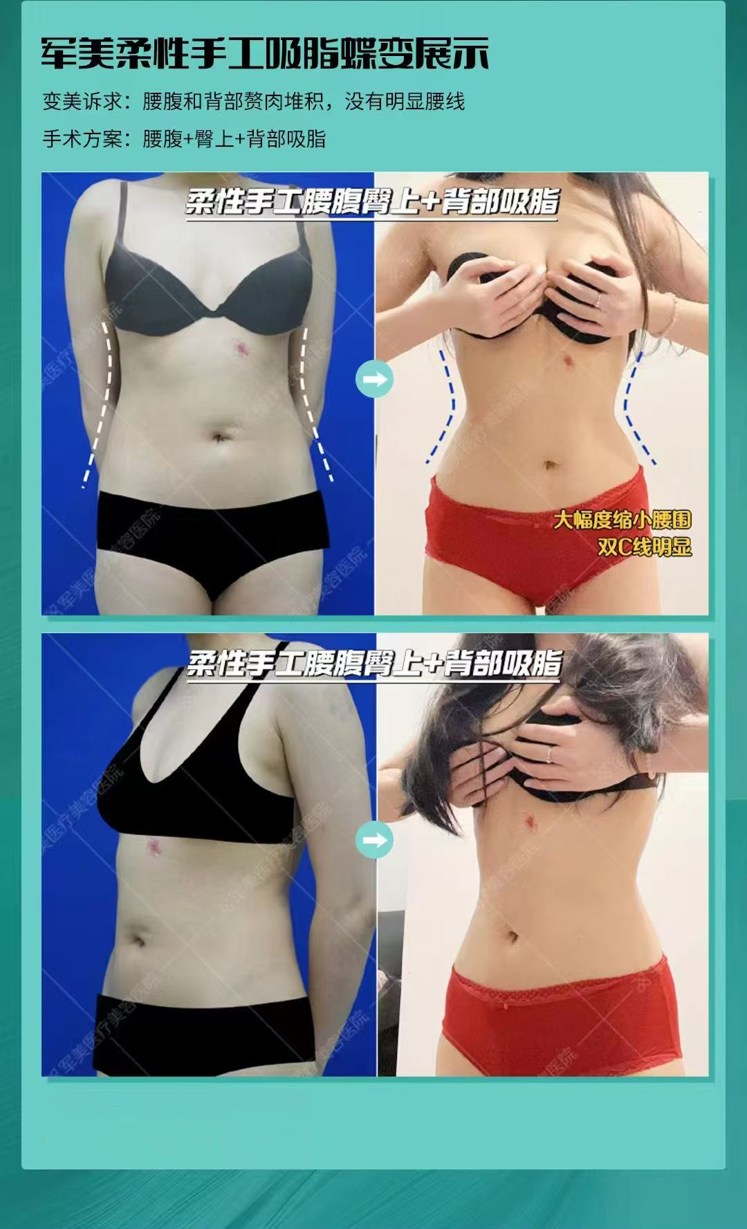 王世虎吸脂案例