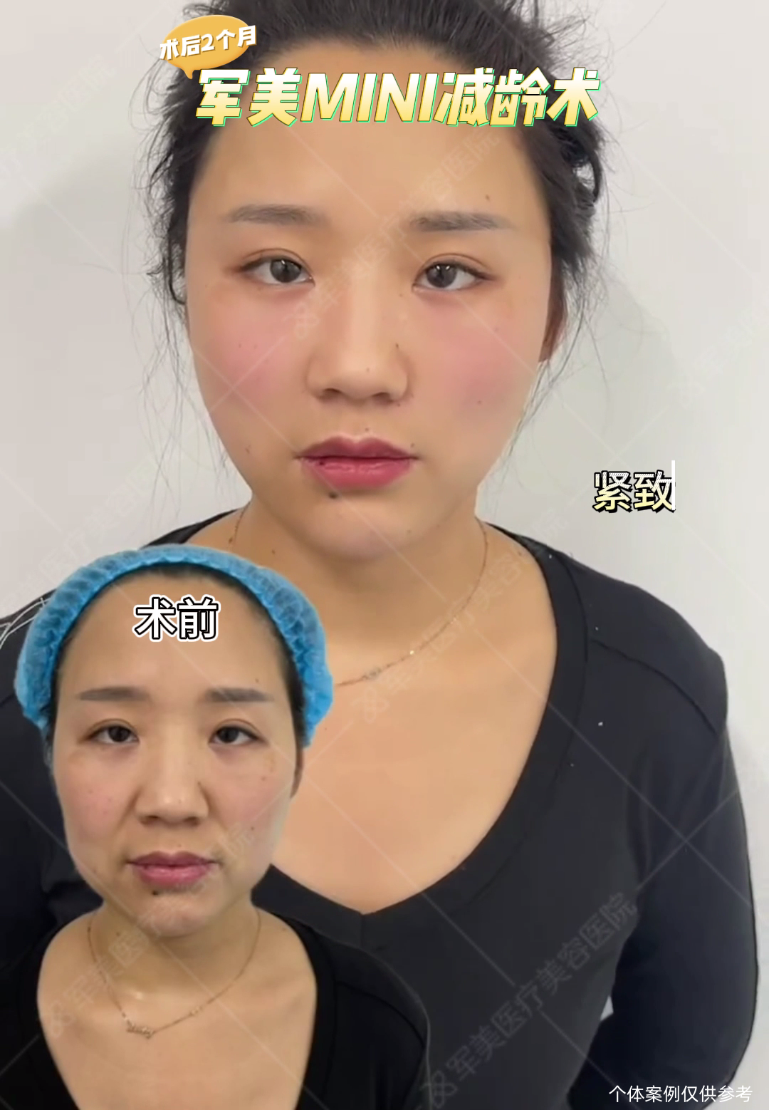 面部衰老改善案例