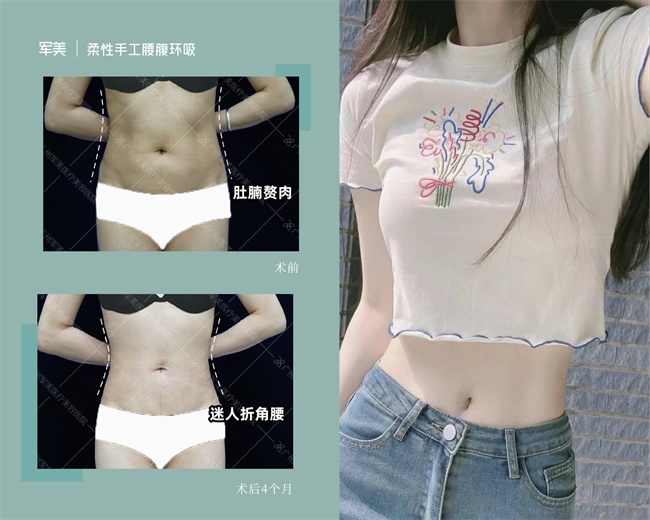 腰腹环吸案例