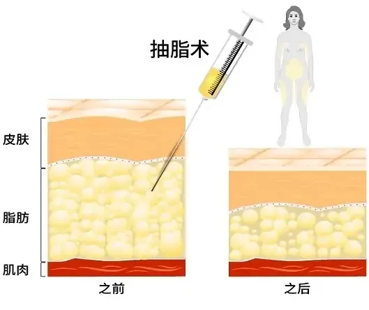 大腿吸脂术后注意事项