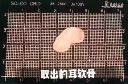 假体隆鼻和自体软骨隆鼻哪个好呢?