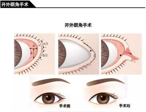 广州开眼角价格？开眼角需要多少钱?