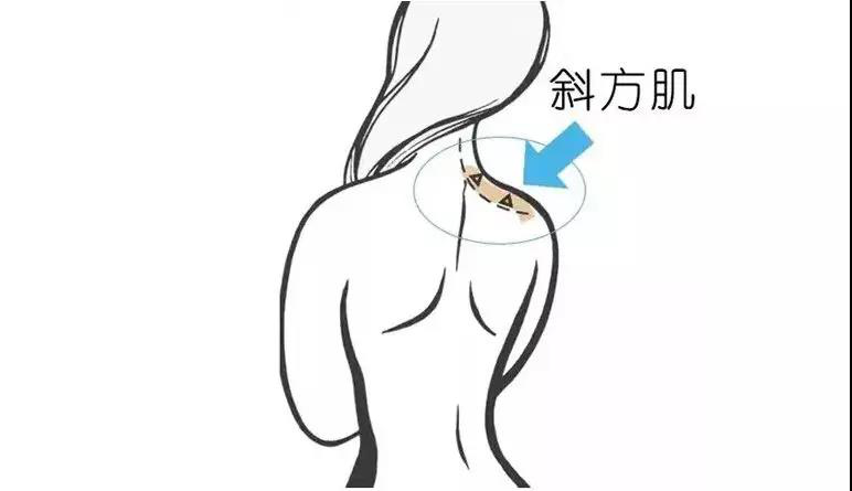  瘦肩针效果怎么样？瘦肩针效果能维持多久？