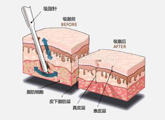 吸脂能不能瘦大腿？大腿吸脂有没有风险？