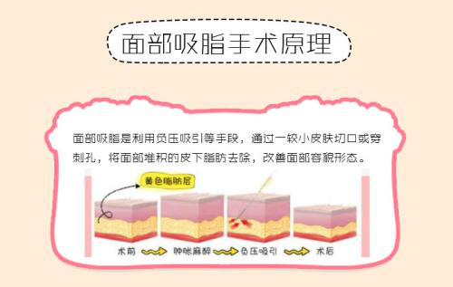 导致面部吸脂瘦脸失败的原因有哪些?
