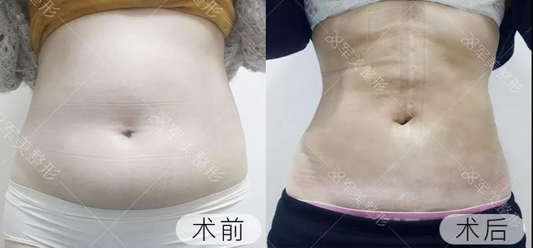 女性做完腰部吸脂术后要多久才能恢复自然?