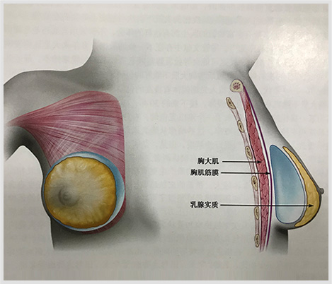 假体隆胸效果