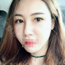 双眼皮术后不对称怎么修复?双眼皮修复最佳时间是多久？